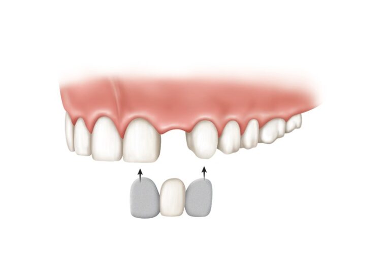 Implants vs. Dentures & Bridges LifeSmiles The Dental Implant Experts